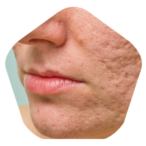 Acne Scar removal clinic in hyderabad