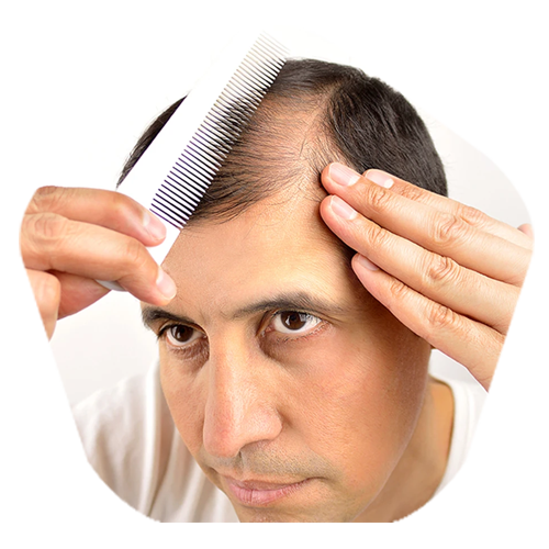Hair Loss treatment in Hyderabad