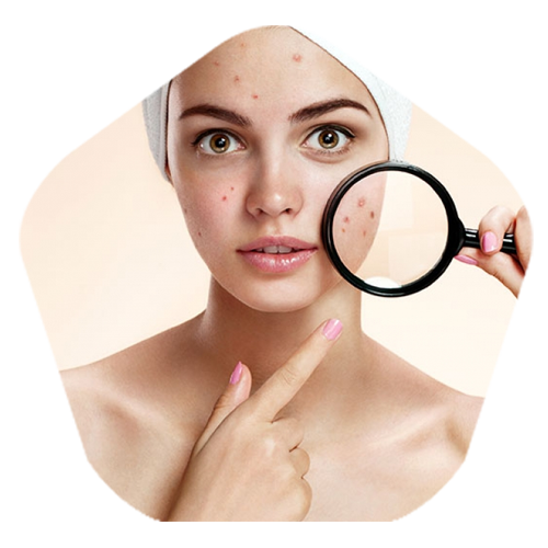 pimples treatment in Kompally