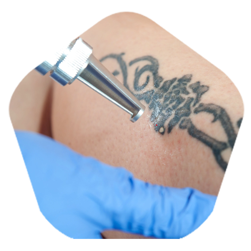 Permanent Tattoo removal in Hyderabad
