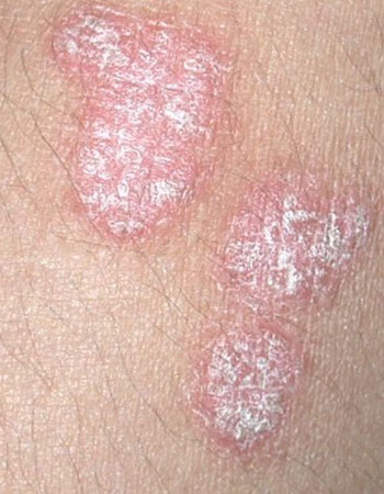 psoriasis treatment in Hyderabad