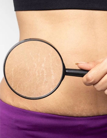 stretch mark removal treatment in Hyderabad