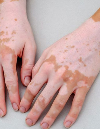 vitiligo specialist in Hyderabad