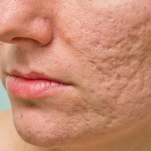 acne scars removal clinic in Hyderabad