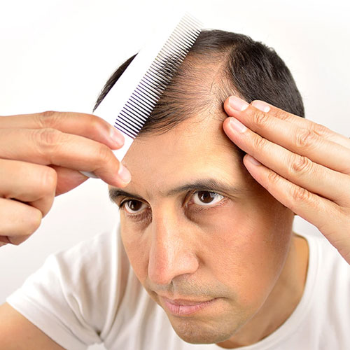 hair loss treatment in Hyderabad