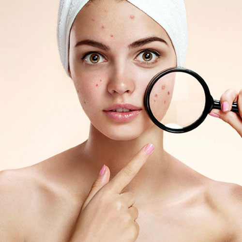 pimples treatment in Hyderabad